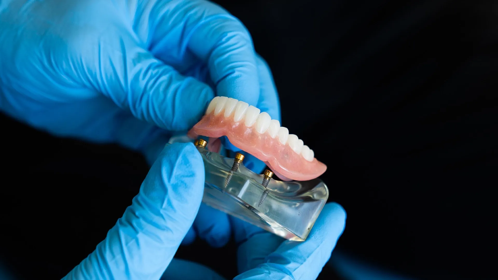 Prótesis dental. Foto: Archivo